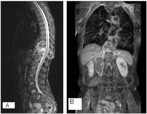 Tuberculoza coloanei vertebrale