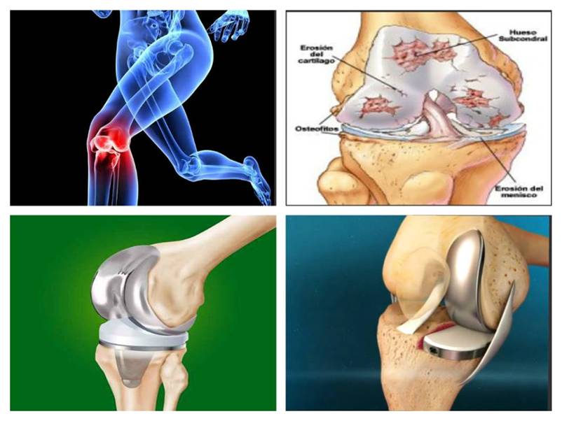Artroza benzii de rulare a genunchiului