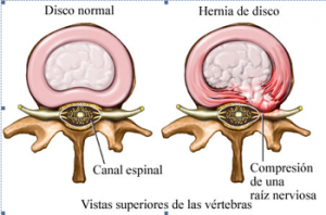 Hernia de disc