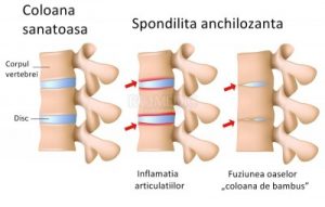 spondiloza anchilozanta