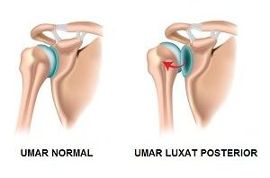 Instabilitatea articulatiei umarului