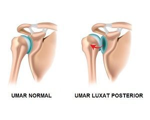 Instabilitatea articulatiei umarului